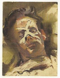 A portrait of a Far East prisoner of war bandaged nose and bruised face laying down, recuperating from a beating.