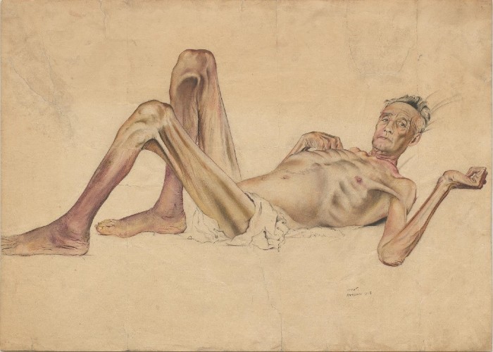 Mr Stanley a Far East prisoner of war laying down showing exhaustion, emaciation and medical neglect.