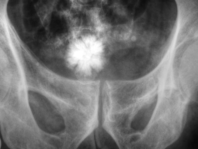 An x-ray of a Jackstone urolith in the bladder