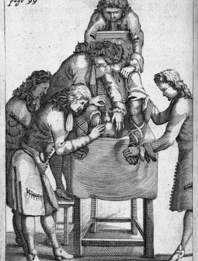 Image from A treatise of lithotomy,1683 (Wellcome Library)